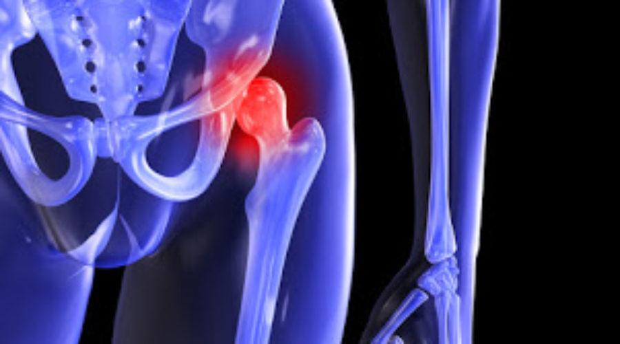 How to avoid hip surgery
